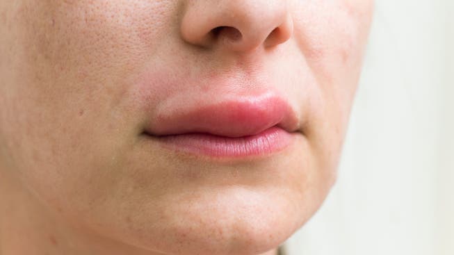Geschwollene Lippen kann es auch bei einer allergischen Reaktion auf eine Impfung geben. Nicht nur bei Lebensmittelunverträglichkeiten.
