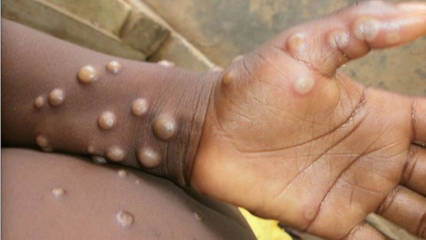 Affenpockenviren führen zu starken Hautausschlägen, die im Gesicht beginnen, sich aber über den ganzen Körper verteilen können. (Bild: WHO/Nigeria Centre Of Disease Control)