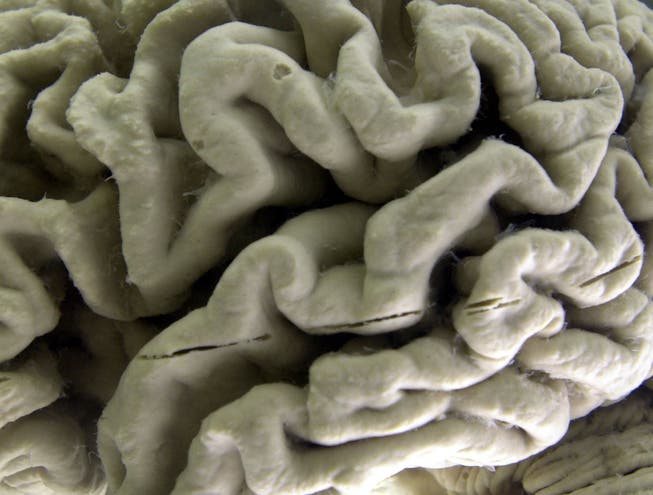 Ein menschliches Hirn, das von der Alzheimer-Erkrankung beschädigt ist.
