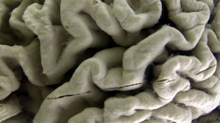 Ein  menschliches Hirn, das von der Alzheimer-Erkrankung beschädigt ist. (David Duprey / AP)