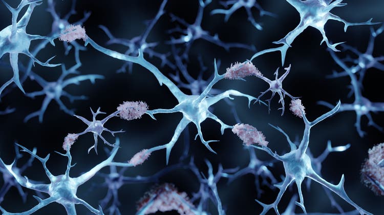 Im Gehirn von Alzheimer-Patienten lagern sich zwischen den Nervenzellen (blau) amyloide Plaques ab. (Shutterstock)